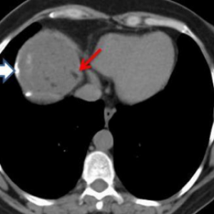 Fat within hepatic hydatid cyst - a case report