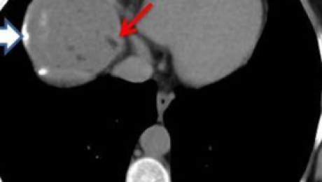 Fat within hepatic hydatid cyst - a case report