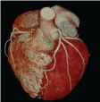 CT Coronary Angio