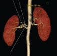CT RENAL ANGIOGRAPHY