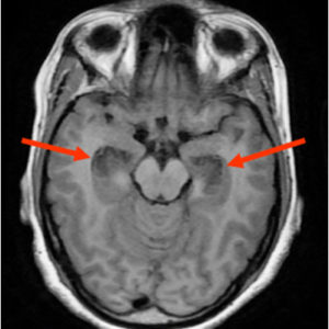 Fig-1-AXIAL MRI BRAIN