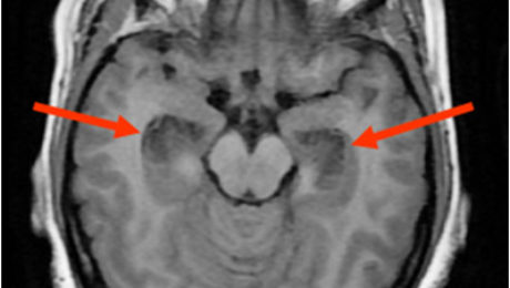 Fig-1-AXIAL MRI BRAIN