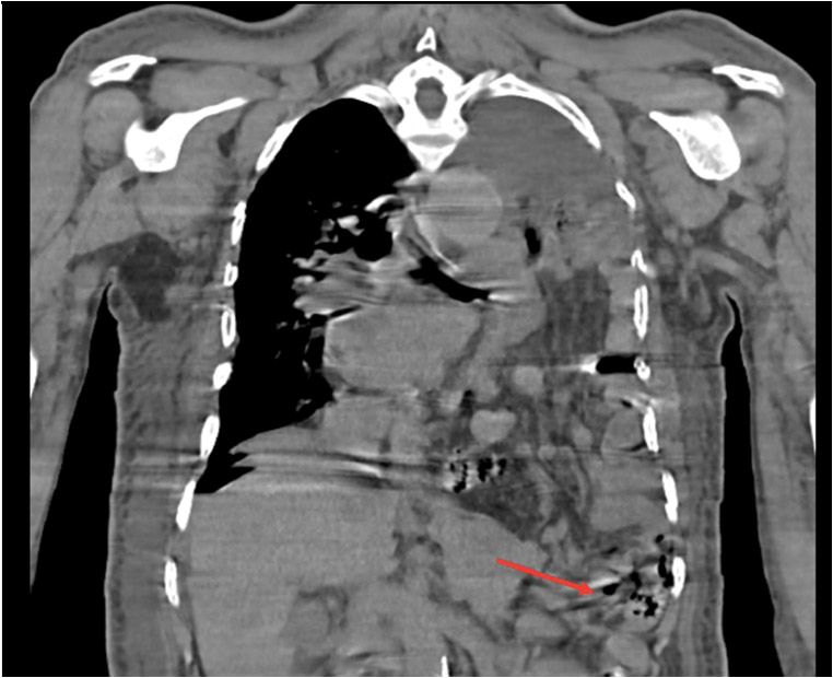 Fig 4-CORONAL SECTION OF PLAIN CT-THORAX